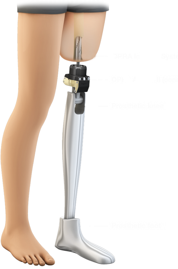 Osseointegration: A Promising Alternative For Amputees - A Step Ahead ...